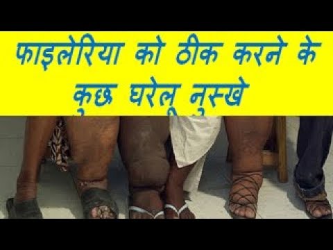 फाइलेरिया को ठीक करने के कुछ घरेलू नुस्खे HOME REMEDIES OF Filaria