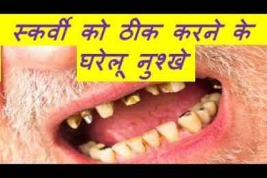 Home Remedies Of Scurvy स्कर्वी को ठीक करने के घरेलू नुश्खे