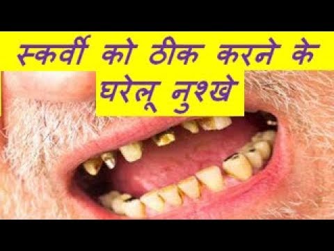 Home Remedies Of Scurvy स्कर्वी को ठीक करने के घरेलू नुश्खे