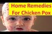 Home Remedies For Chicken Pox चिकन पॉक्स से बचाव के लिए घरेलू नुस्खे