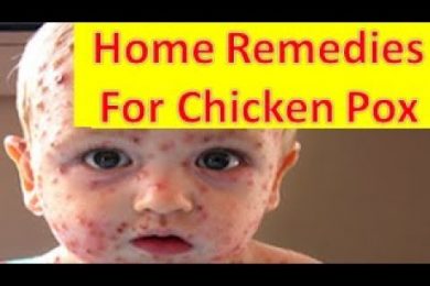 Home Remedies For Chicken Pox चिकन पॉक्स से बचाव के लिए घरेलू नुस्खे