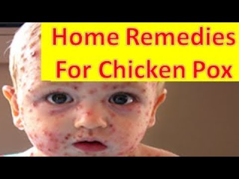 Home Remedies For Chicken Pox चिकन पॉक्स से बचाव के लिए घरेलू नुस्खे