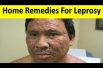 Home Remedies For Leprosy कुष्ठ रोग को ठीक करने के घरेलू नुस्खे