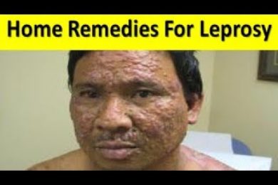 Home Remedies For Leprosy कुष्ठ रोग को ठीक करने के घरेलू नुस्खे