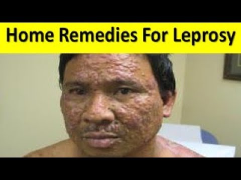 Home Remedies For Leprosy कुष्ठ रोग को ठीक करने के घरेलू नुस्खे