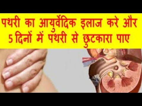 पथरी का आयुर्वेदिक इलाज करे और 5 दिनों में पथरी से छुटकारा पाए Ayurvedic Treatment Of Stones