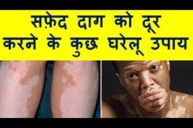 सफ़ेद दाग को दूर करने के कुछ घरेलू उपाय Leucoderma Treatment