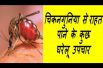 चिकनगुनिया से राहत पाने के कुछ घरेलू उपचार   Home Remedy For chikungunya
