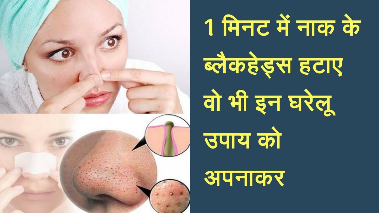 13 Natural Ways to Remove Blackheads | home remedies reduce Blackheads |