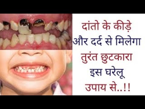 Home remedies for teeth इस घरेलू उपाय से दांतो के कीड़े और दर्द से मिलेगा तुरंत छुटकारा