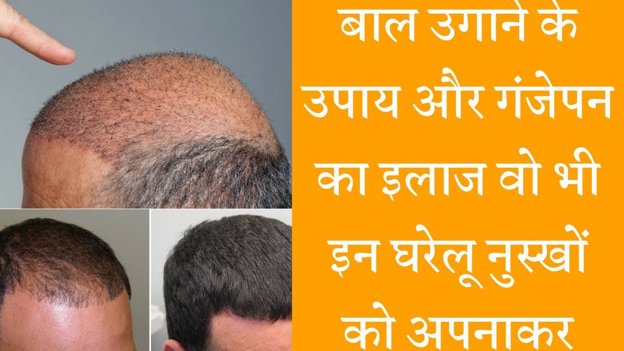 Home Remedies for Hair Loss  सताने लगा है गंजापन तो अपनाए ये उपाय