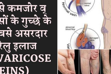 Varicose Veins Home Treatment  वेरिकोज वैन (नसे कमजोर व् नसों के गुच्छे)के सबसे असरदार घरेलु इलाज
