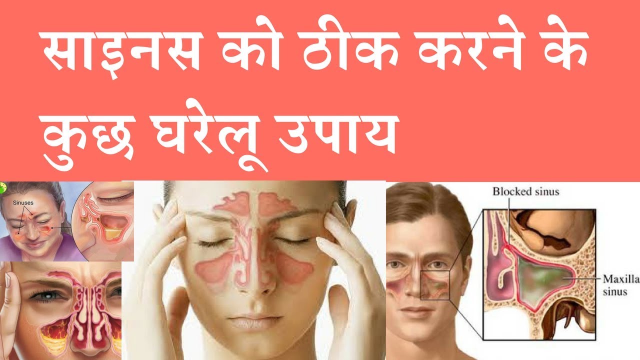 Natural Remedies for Sinus Pain साइनस ठीक करने वाला असरदार घरेलू उपाय