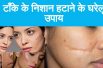 How to remove stitches marks in home remedy टाँके के निशान हटाने के घरेलू उपाय