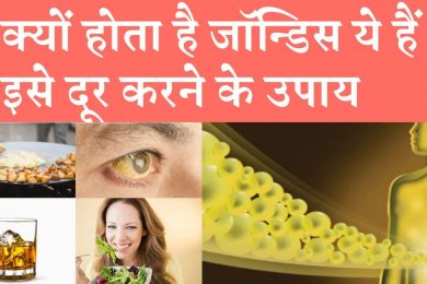 Home Remedies To Get Rid Of Jaundice क्यों होता है जॉन्डिस ये हैं इसे दूर करने के उपाय
