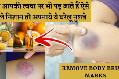 Best Home Remedies To Remove Body Bruise Marks | शरीर पर दिखे ऐसे नील के निशान, तो आप हो जाएं सावधान