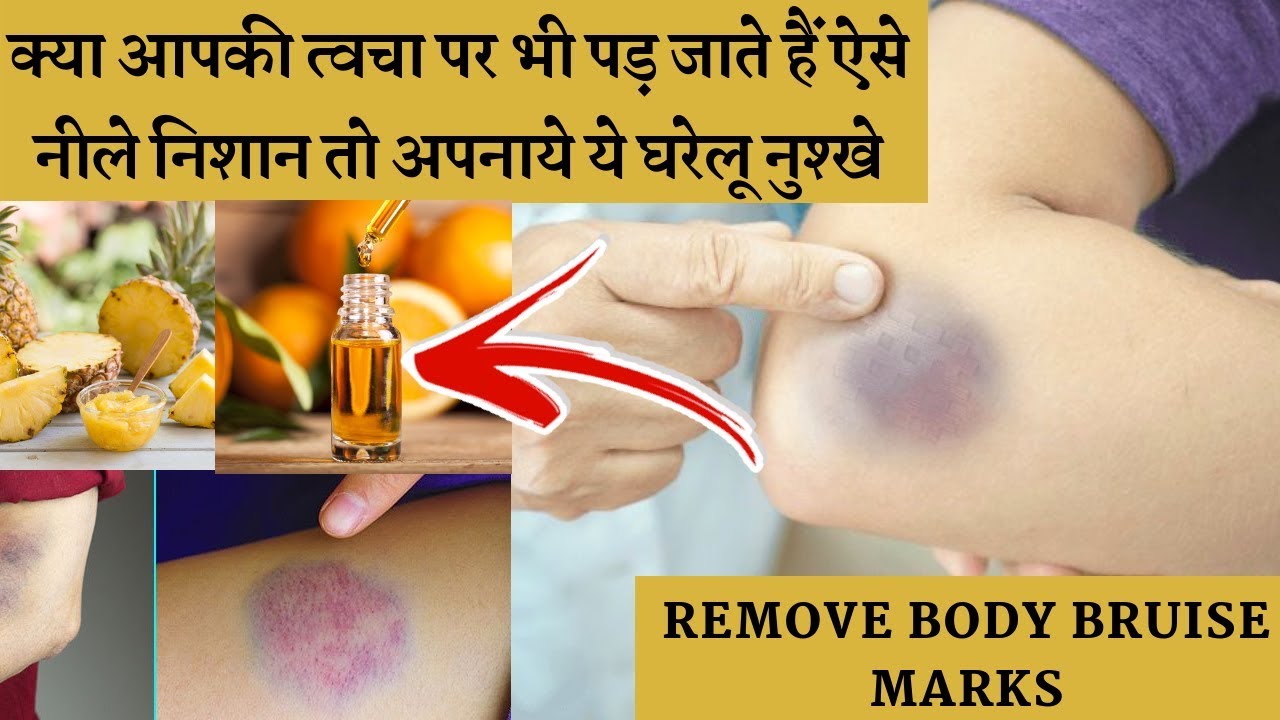 Best Home Remedies To Remove Body Bruise Marks | शरीर पर दिखे ऐसे नील के निशान, तो आप हो जाएं सावधान