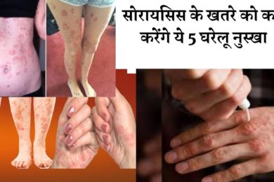 सोरिसिस के खतरे से बचना है तो आज से ही फॉलो करे इन नुश्को को?☝️