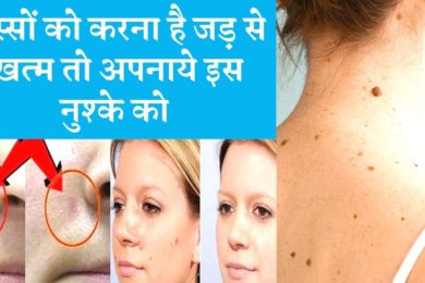 मस्सों को जड़ से गायब कर देगा ये घरेलू नुस्खा जाने क्या✌️  Wart Removal Tips☺️