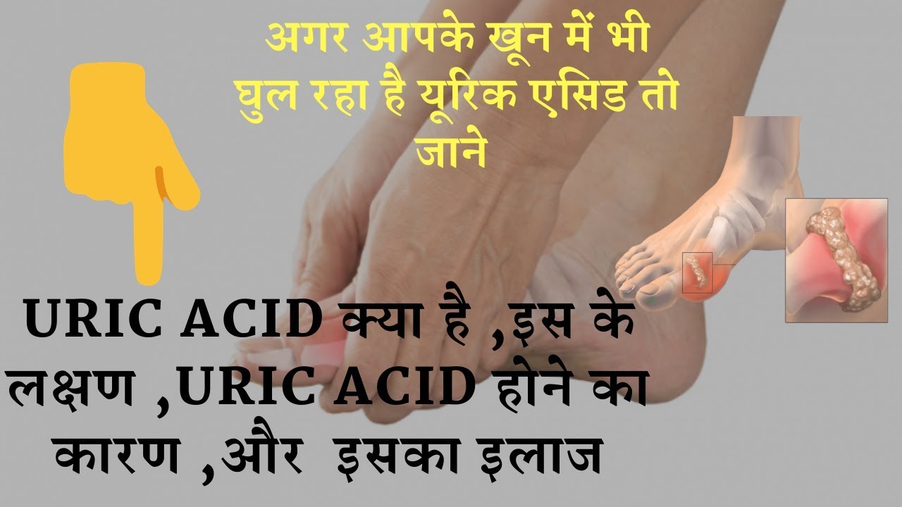 Reduce Uric Acid Levels,Herbal Gout Treatment  | यूरिक एसिड के लक्षण, कारण, इलाज, जाने