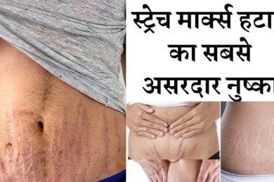 Stretch marks will reduce by these home remedies जिद्दी से जिद्दी स्ट्रेच मार्क्स को हाटए इन तरीको स