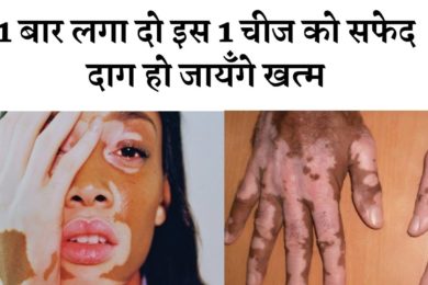 बस 1 बार लगा दो इस 1 चीज को सफेद दाग हो जायँगे खत्म #whitespots