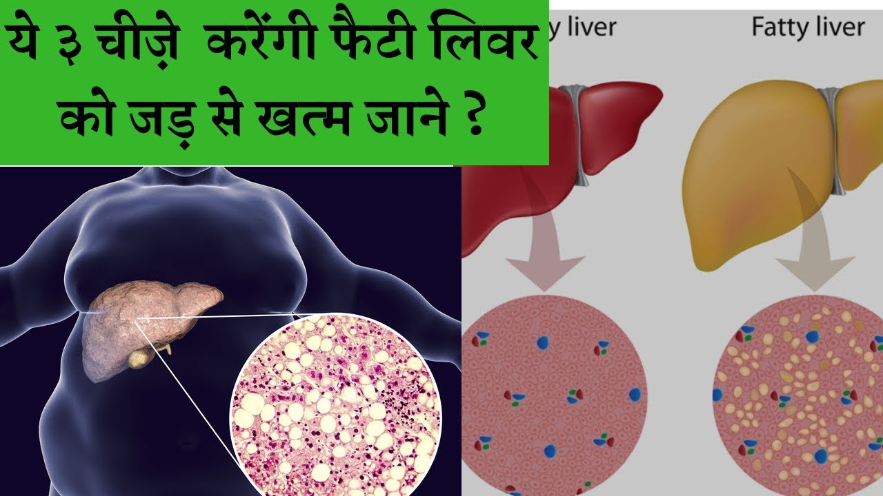 फैटी लिवर को खत्म करेंगी ये 3 चीज़े || Fatty liver disease