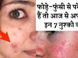 Get rid of easily if you are troubled by boils and pimples || 7 उपाय दिलाएंगे  फोड़े फुंसी से छुटकार