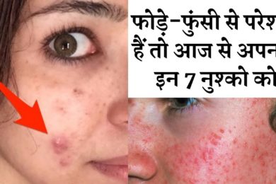 Get rid of easily if you are troubled by boils and pimples || 7 उपाय दिलाएंगे  फोड़े फुंसी से छुटकार