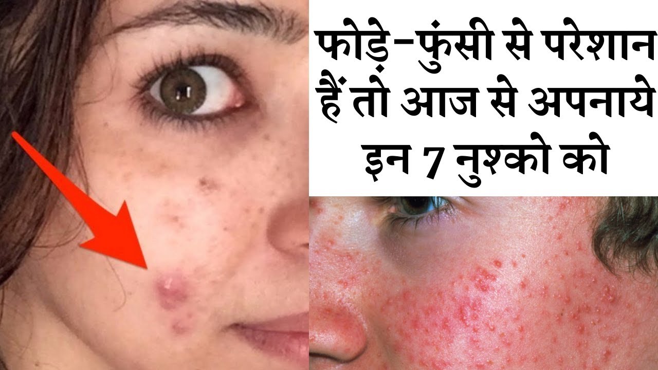 Get rid of easily if you are troubled by boils and pimples || 7 उपाय दिलाएंगे  फोड़े फुंसी से छुटकार