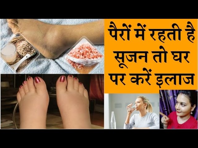 Home remedies to treat swollen feet पैरों में रहती है सूजन तो करें ये इलाज,