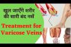 Treatment for Varicose Veins  | बंद नसों के लिए घरेलू उपाय   Home remedies Nerve pain in hindi