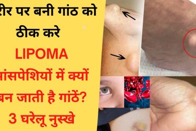 Home remedies muscle lumps || मांसपेशियों में क्यों बन जाती है गांठें | LIPOMA || How To Cure Lump