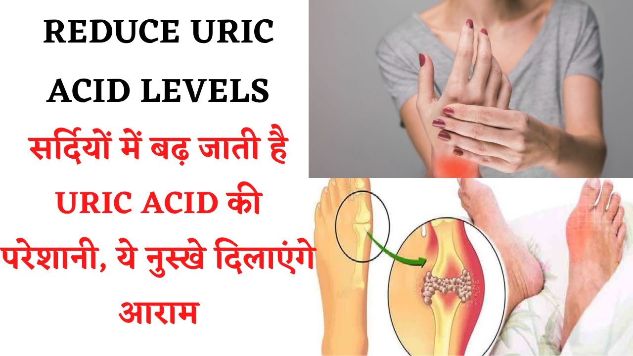 Uric Acid Symptoms And Home Remedies || ये नुस्खे दिलाएंगे Uric Acid की परेशानी आराम