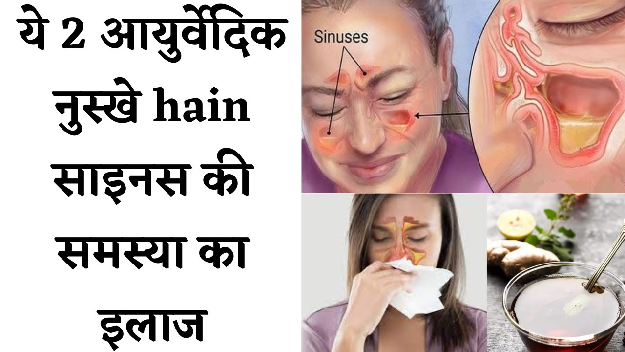 Ayurvedic treatment for sinus सायनस से हैं परेशान तुरंत अपनाएं ये देसी इलाज, होगा फायदा Nazla zukam