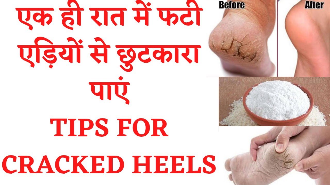 Home Remedies for Cracked Heels / जानें फटी एड़‍ियां ठीक करने के उपाय